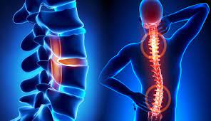 Spinal Diseases Image